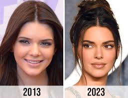 Kendall Jenner Before Surgery